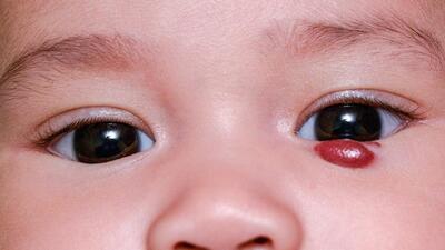 U máu vùng hàm mặt ở trẻ có cần điều trị?