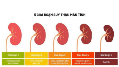 Bệnh thận mạn tính “trẻ hóa": Hồi chuông cảnh tỉnh về lối sống của giới trẻ