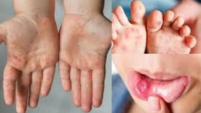 PHÒNG BỆNH TAY CHÂN MIỆNG TẠI CỘNG ĐỒNG