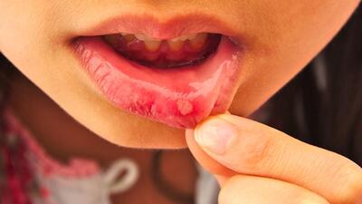 Bị tưa miệng, nhiệt miệng chữa thế nào?