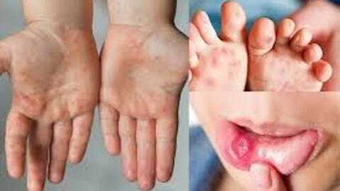 PHÒNG BỆNH TAY CHÂN MIỆNG TẠI CỘNG ĐỒNG