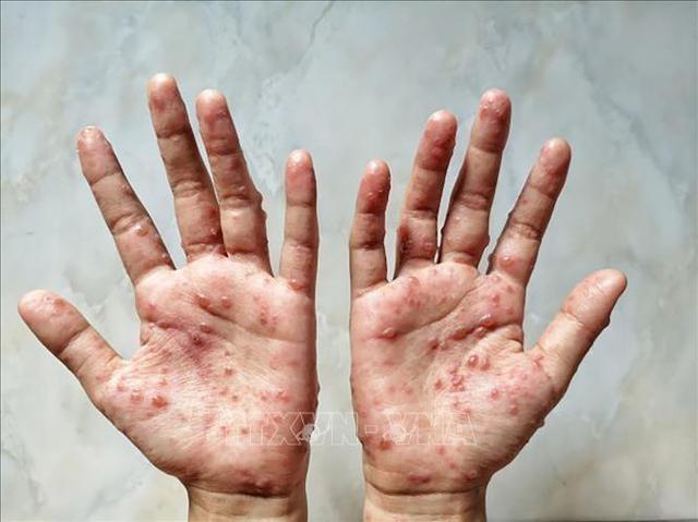 Thủ tướng yêu cầu tăng cường công tác phòng, chống bệnh Đậu mùa khỉ - Ảnh 2.