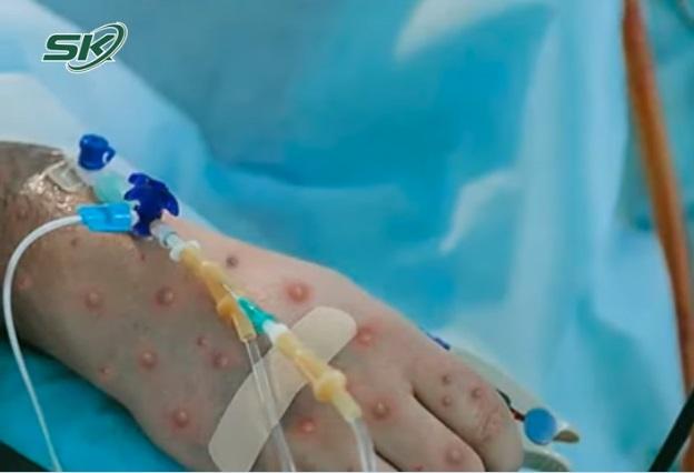 Nóng: Bệnh nhân đầu tiên mắc đậu mùa khỉ tại Việt Nam là nữ, khởi phát bệnh khi đang đi du lịch - Ảnh 2.
