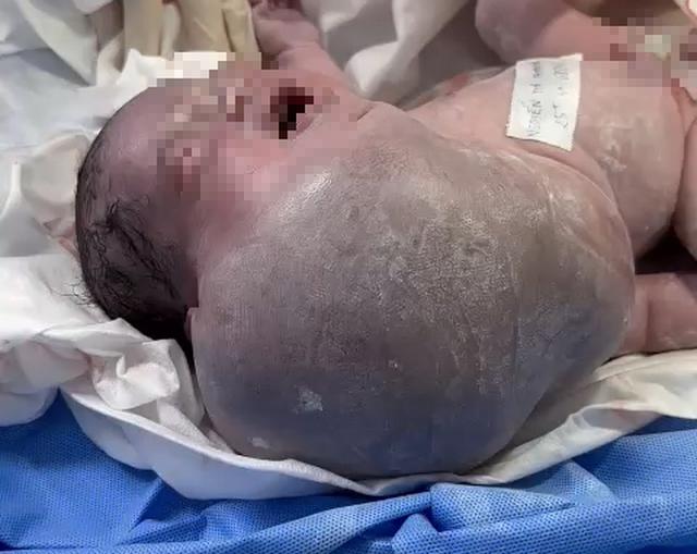 TP.HCM: Bé sơ sinh có khối bướu vùng mặt, cổ, ngực khủng nhất trong y văn thế giới - Ảnh 2.