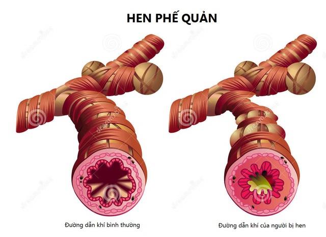 Cần làm gì để xử trí kịp thời cơn hen cấp ở trẻ? - Ảnh 2.