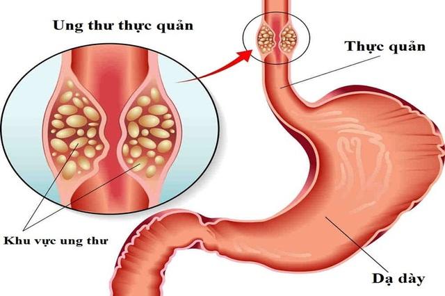 Bệnh trào ngược dạ dày thực quản có dẫn đến ung thư không? - Ảnh 2.