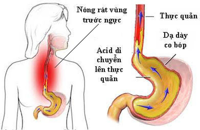 Mẹo ăn uống tốt cho người bị trào ngược dạ dày-thực quản - Ảnh 2.