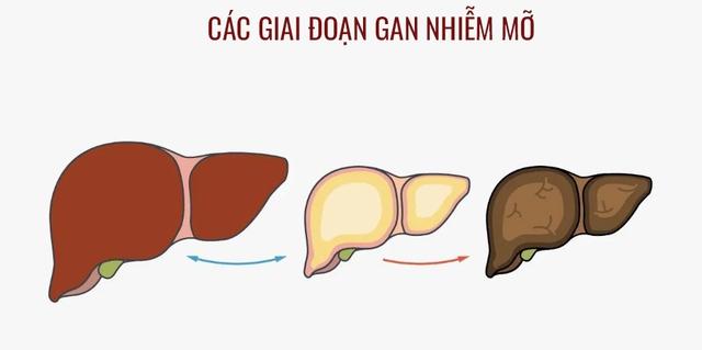 Gan nhiễm mỡ có chữa được không? - Ảnh 2.