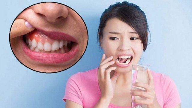 Viêm quanh răng: Nguyên nhân, biểu hiện và điều trị - Ảnh 3.