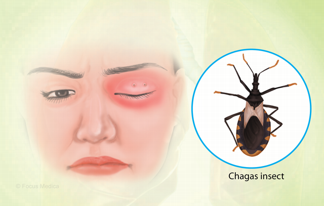 Ngày bệnh sán lá gan Chagas 14/4: Triệu chứng, đường lây truyền và điều trị bệnh sán lá gan Chagas thế nào? - Ảnh 2.