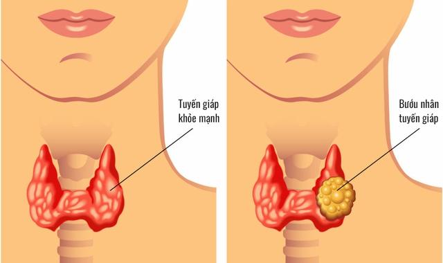 Tuyến giáp là một tuyến nội tiết quan trọng trong cơ thể.Một trong những nguyên nhân gây hiếm muộn ở phụ nữ được xác định là do bệnh lý của tuyến giáp.