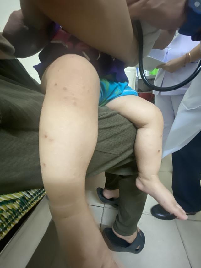 Hà Tĩnh chủ động phòng bệnh tay chân miệng trong mùa tựu trường - Ảnh 2.