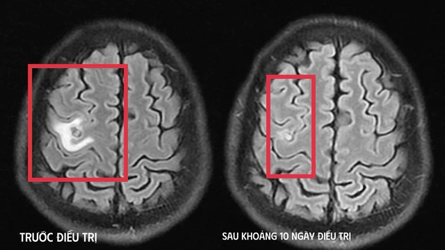 Sán dây chó làm tổ trong não, người đàn ông suýt nhầm với u não