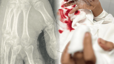 Trẻ 15 tuổi bị biến dạng khuôn mặt, tổn thương nghiêm trọng do tai nạn pháo nổ