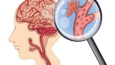 Áp lực, cường độ làm việc cao kéo dài có làm tăng nguy cơ đột quỵ ở người trẻ?
