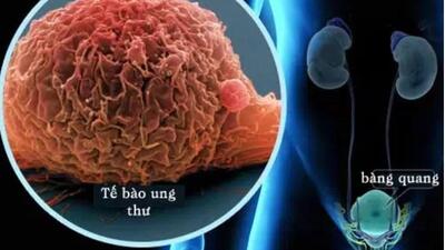 Tiểu máu, sụt cân... cảnh giác với ung thư bàng quang