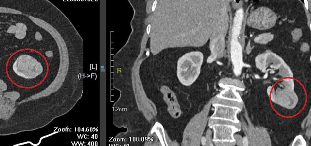 Mổ ruột thừa, bác sĩ phát hiện ung thư thận ở bệnh nhân 76 tuổi
