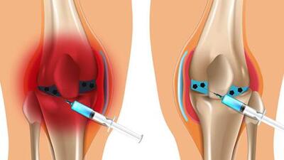 Tràn dịch khớp gối: Đừng chủ quan khi đầu gối sưng đau
