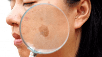 Nhận diện thủ phạm gây đốm đồi mồi trên da