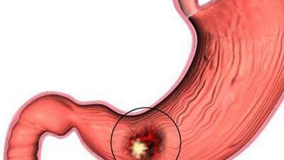 Viêm loét dạ dày dễ tái phát vào dịp cuối năm