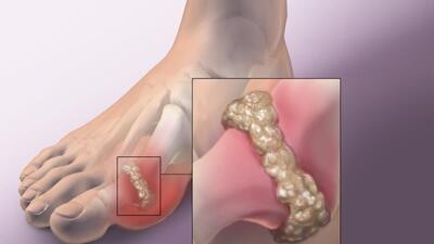 Người bệnh gout khổ sở với tiệc tùng cuối năm