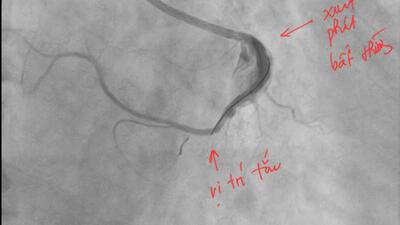 Cứu sống người đàn ông nhồi máu cơ tim cấp dị dạng động mạch vành hiếm gặp