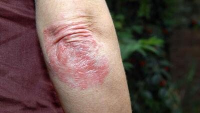 Thêm lựa chọn điều trị vảy nến mức độ trung bình đến nặng