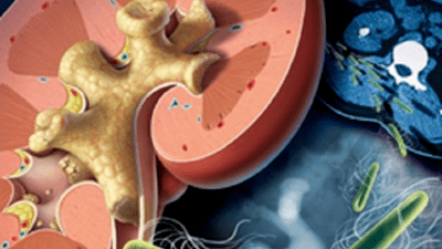 Sỏi san hô nguy hiểm nhận biết ra sao?