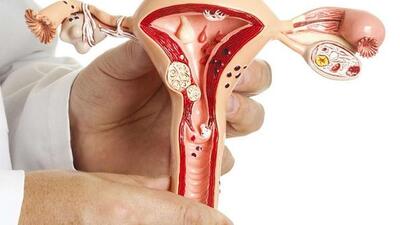 Vì sao nhân xơ tử cung khiến phụ nữ khó có thai?