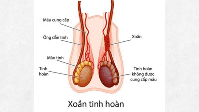 Nam sinh 14 tuổi phải cắt bỏ tinh hoàn do nhập viện muộn