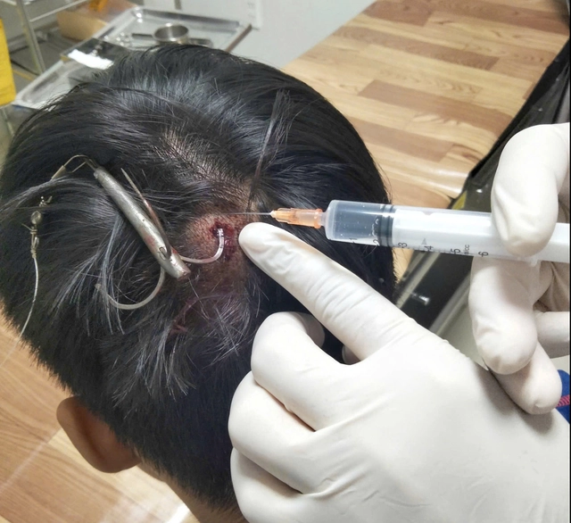 Móc câu 3 tiêu cắm sâu vào đỉnh đầu thiếu niên