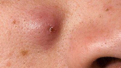 Mụn bọc trên mặt dễ biến chứng nếu tự ý nặn mụn