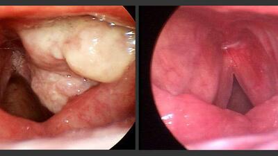 Viêm thanh quản có dẫn đến ung thư không?