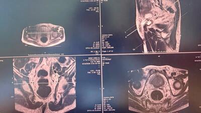 Sinh thiết đích qua tầng sinh môn, bệnh nhân ung thư tiền liệt tuyến được can thiệp kịp thời, điều trị ổn định