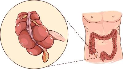Viêm ruột thừa dễ nhầm lẫn và có thể gây biến chứng gì?