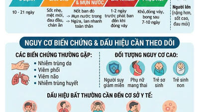 Chủ động phòng, chống bệnh thủy đậu – Bảo vệ sức khỏe cộng đồng