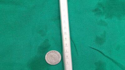 Bệnh viện Đa khoa tỉnh: Xử trí thành công trường hợp nuốt phải đồng xu