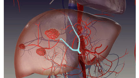 Đau tức hạ sườn, ăn kém, sút cân… cảnh giác với u máu gan