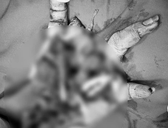 Nam sinh bị dập nát bàn tay do pháo nổ