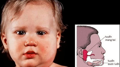 Bệnh quai bị bao lâu thì khỏi?