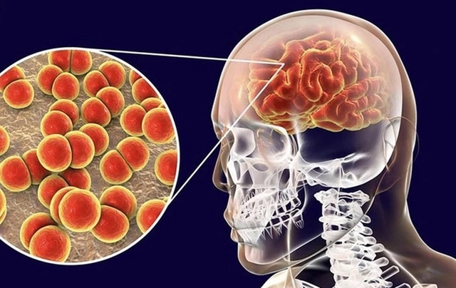 Não mô cầu gây tử vong nhanh, người dân cần làm gì để tự bảo vệ?
