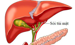 Dấu hiệu cảnh báo sỏi túi mật, nhận biết sớm để tránh biến chứng nguy hiểm