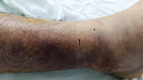 Liên tiếp ca nhập viện nguy kịch do rắn cắn, cách xử trí đúng tránh biến chứng