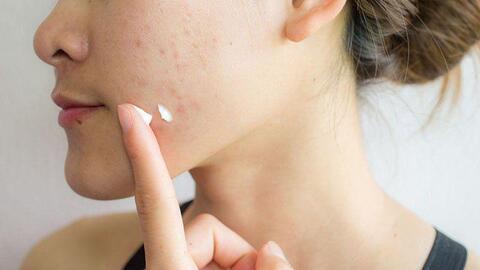 6 sai lầm khi chữa mụn trứng cá