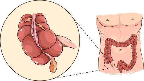 Viêm ruột thừa dễ nhầm lẫn và có thể gây biến chứng gì?