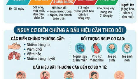 Chủ động phòng, chống bệnh thủy đậu – Bảo vệ sức khỏe cộng đồng