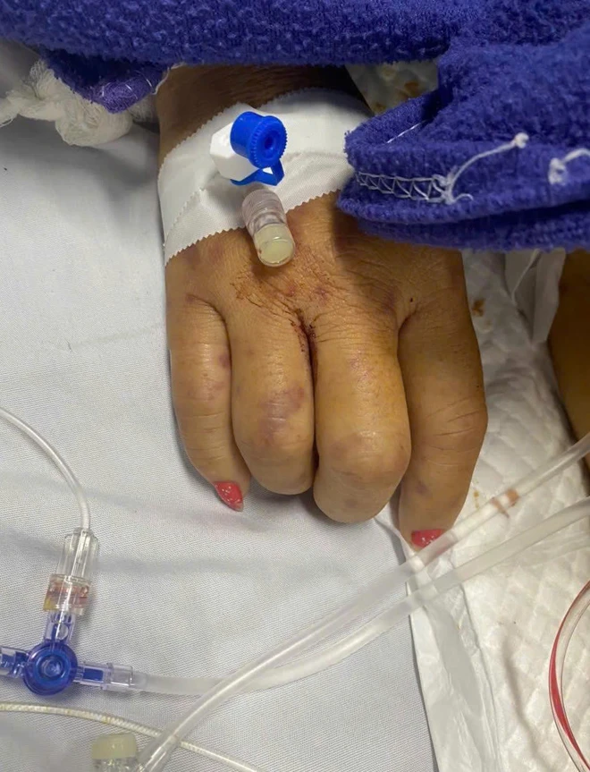 Chủ quan vì triệu chứng giống cúm, người phụ nữ nguy kịch do nhiễm não mô cầu