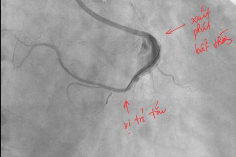 Cứu sống người đàn ông nhồi máu cơ tim cấp dị dạng động mạch vành hiếm gặp