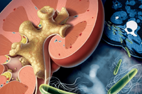 Sỏi san hô nguy hiểm nhận biết ra sao?