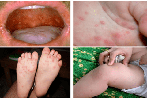 Tay chân miệng gia tăng, cảnh báo chủng EV71 độc lực cao, Bộ Y tế yêu cầu chủ động điều trị, kiểm soát lây nhiễm